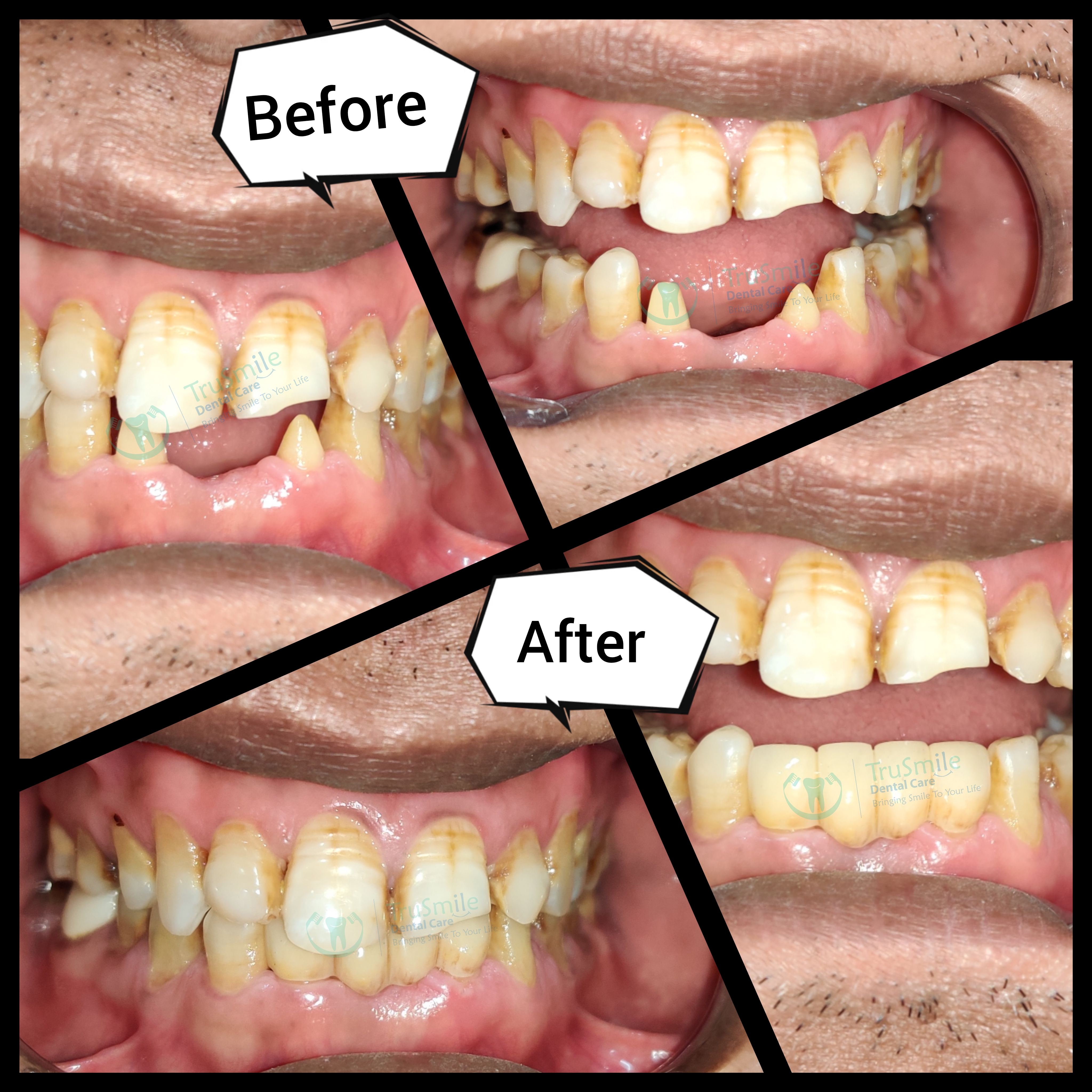 Zirconia 6